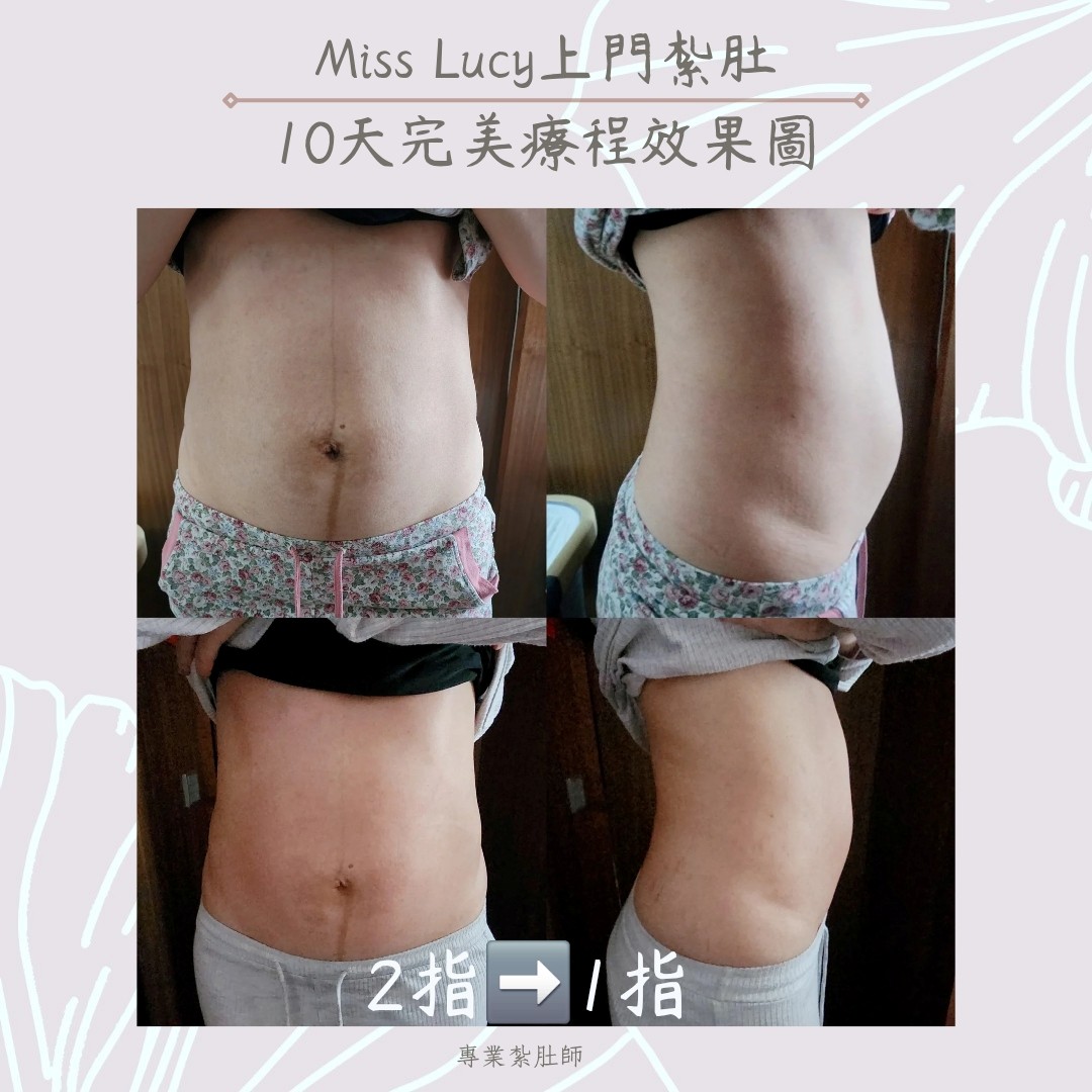 Miss Lucy 上門紮肚 10 天療程效果示例