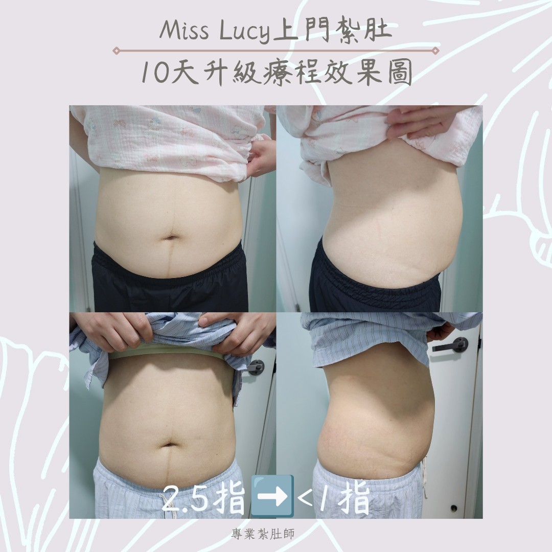 Miss Lucy 上門紮肚療程效果圖 3