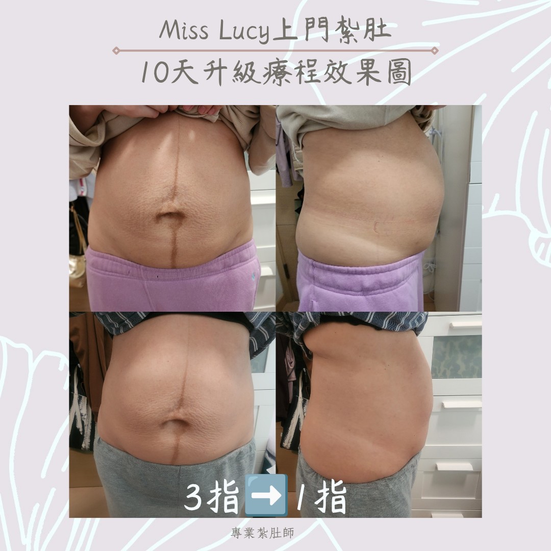 Miss Lucy 上門紮肚療程效果圖 4