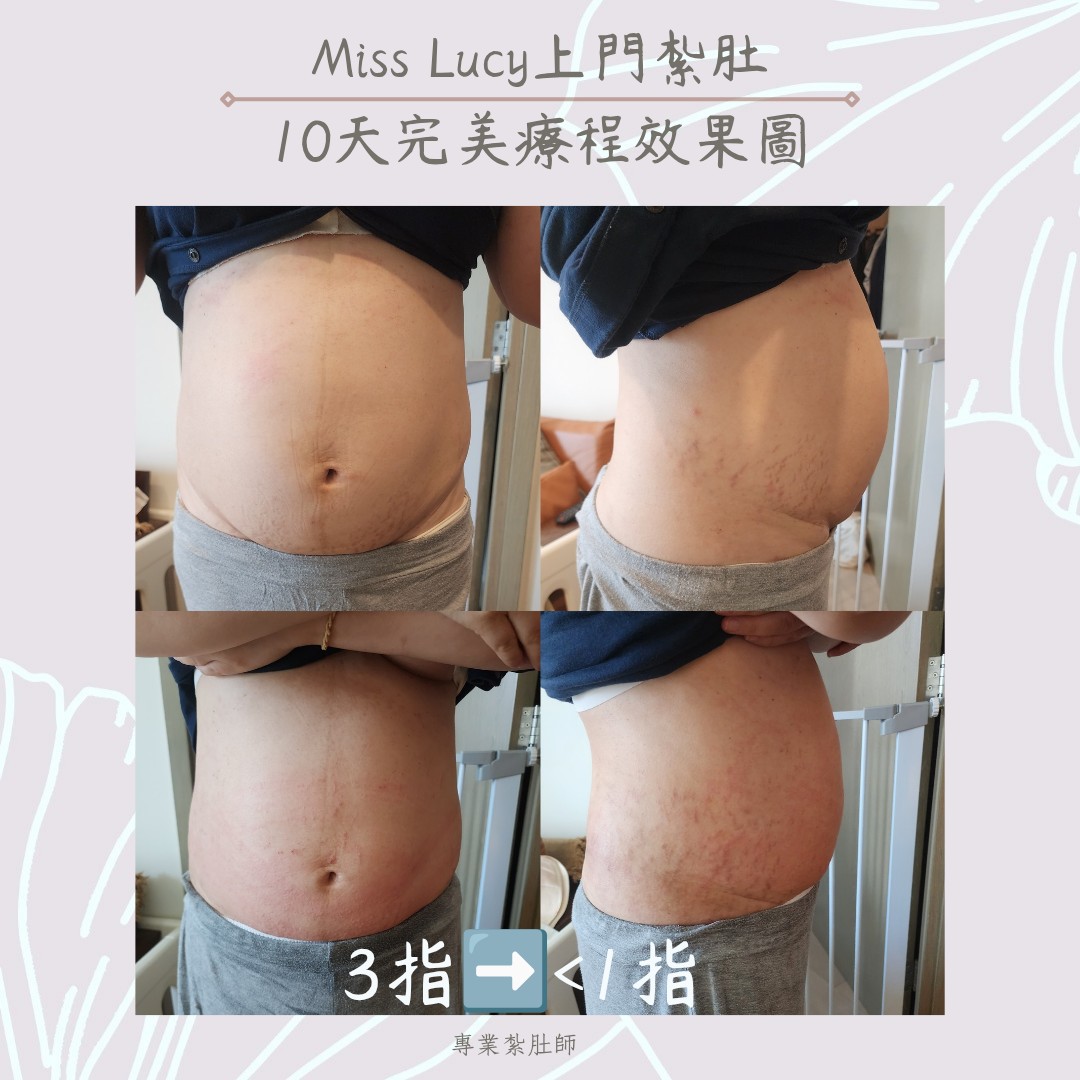 Miss Lucy 上門紮肚療程效果圖 13