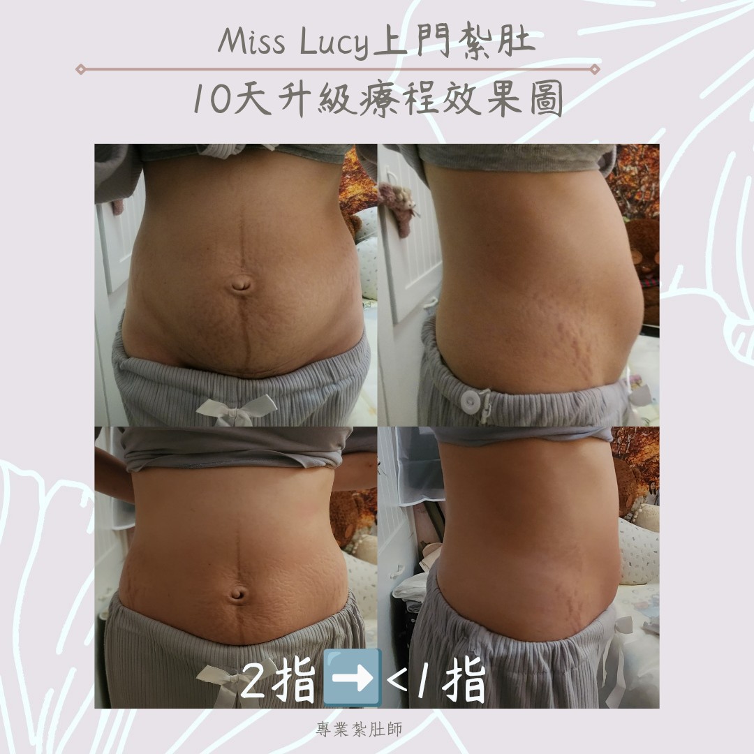 Miss Lucy 上門紮肚療程效果圖 18