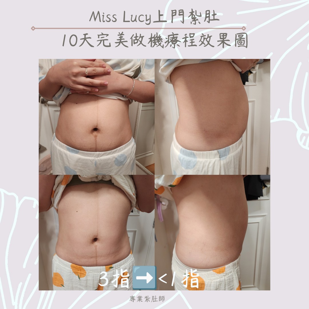 Miss Lucy 上門紮肚療程效果圖 21